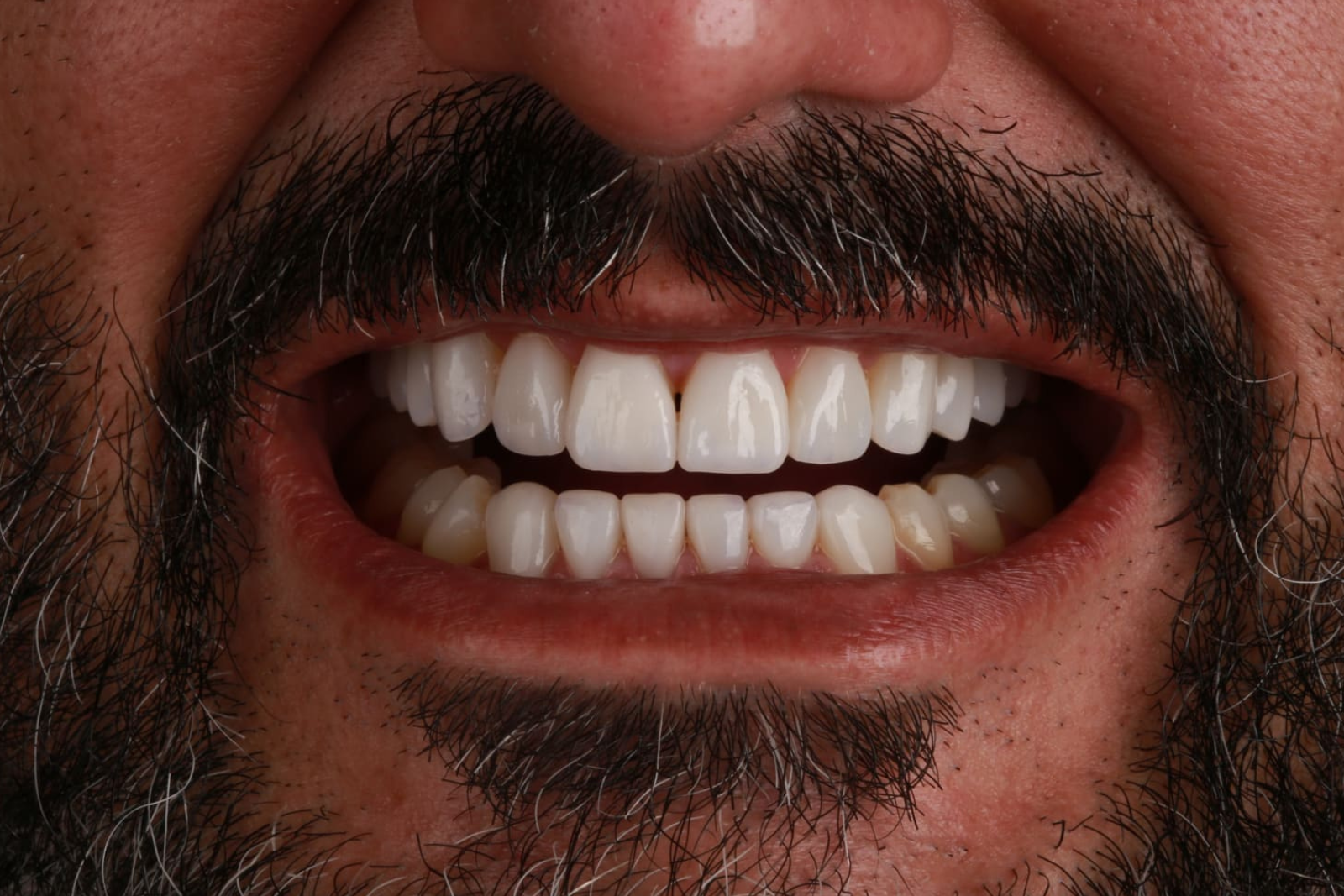 Depois: Clareamento Dental