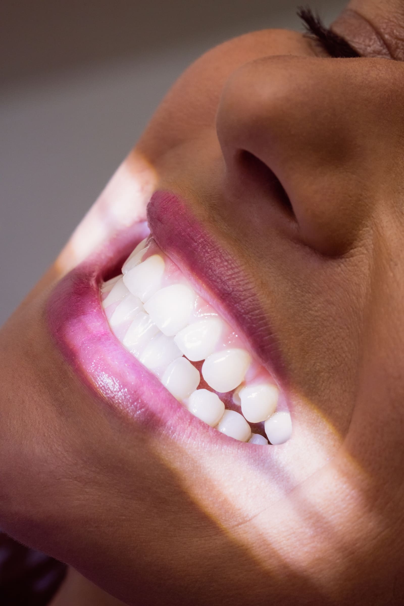 Facetas de Porcelana
